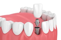 Periodontics and Dental Implants of North Carolina Photo