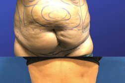 Liposuction NYC: The Lipo Group (New York Office) in New York City